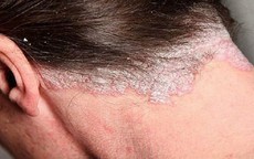 Ai dễ bị nhiễm nấm da đầu, biểu hiện nấm da đầu?