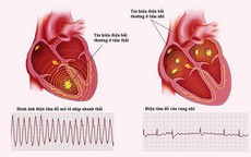 Tại sao rung nhĩ lại nguy hiểm?