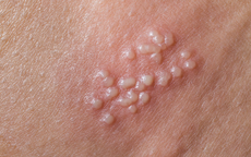 Nguy&#234;n&#160;nh&#226;n&#160;g&#226;y&#160;bệnh&#160;mụn&#160;rộp&#160;sinh&#160;dục