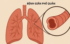 Ho ra m&#225;u&#160;cần cảnh gi&#225;c với&#160;gi&#227;n phế quản