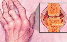 Vi&#234;m khớp dạng thấp ảnh hưởng đến cơ thể như thế n&#224;o?