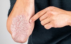 Bệnh vảy nến: dấu hiệu nhận biết v&#224; những ai c&#243; nguy cơ cao?