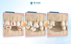C&#243; n&#234;n trồng răng số 6 (răng cấm) khi mất răng, chi ph&#237; c&#243; đ&#225;ng với chất lượng?