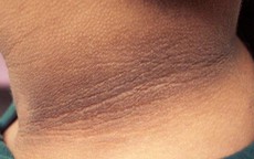 Bệnh&#160;gai&#160;đen&#160;xảy&#160;ra&#160;do&#160;nguy&#234;n&#160;nh&#226;n&#160;n&#224;o?