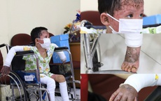 Bệnh nhi bỏng 65% vụ ph&#243;ng hỏa ở Gia Lai hồi phục ngoạn mục sau 38 ng&#224;y điều trị