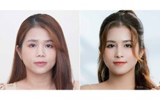 V&#236; sao nhiều người cần t&#225;i tạo mũi hỏng chỉ sau 1-2 năm?