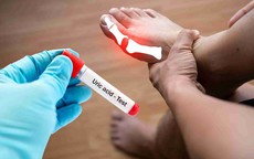 5 loại đồ uống khi đ&#243;i gi&#250;p hạ axit uric cao