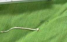 Phẫu thuật khối u, phát hiện ký sinh trùng dạng sán trong vùng hố chậu bệnh nhân