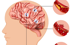 Bệnh nhân 87 tuổi hôn mê sâu do xuất huyết não, cảnh báo nguy cơ và cách phòng ngừa căn bệnh nguy hiểm