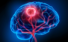 Tưởng ngất do đột quỵ, người phụ nữ 36 tuổi bất ngờ phát hiện ung thư máu