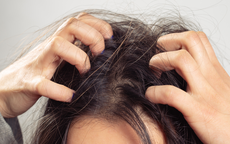 Da đầu g&#224;u – ngứa k&#233;o d&#224;i: 6 nguy&#234;n nh&#226;n &#237;t ai ngờ tới khiến vấn đề trở nặng