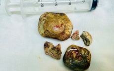 Phẫu thuật khối sỏi bàng quang kích thước lớn cho bệnh nhân mắc nhiều bệnh lý nền