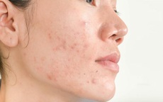 Top gel ngừa mụn được nhiều người lựa chọn trong năm 2025