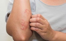 Viêm da cơ địa dễ tái phát khi thời tiết thay đổi