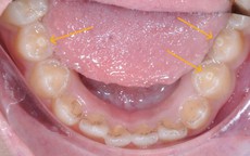 Răng c&#243; n&#250;m phụ – nguy cơ biến chứng nếu kh&#244;ng điều trị kịp thời