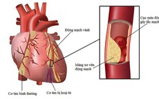5 biện ph&#225;p giảm nguy cơ biến cố tim mạch khi thời tiết lạnh