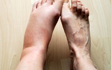Các thuốc gây phù chân, xử trí như thế nào?