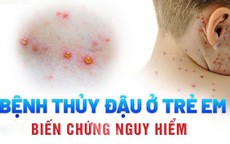 Cứu sống bé sơ sinh 15 ngày tuổi bị thủy đậu biến chứng ác tính