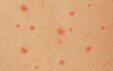 Cẩn trọng với bệnh thủy đậu gây biến chứng