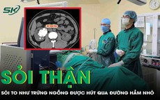 Phẫu thuật lấy sỏi thận to như quả trứng ngỗng cho người đàn ông 47 tuổi