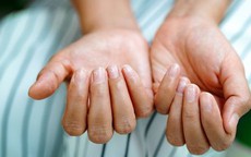 Bổ sung vitamin v&#224; kho&#225;ng chất n&#224;o khi m&#243;ng tay gi&#242;n, dễ g&#227;y?