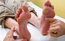 Tổn thương b&#224;n ch&#226;n ở người tiểu đường cần ph&#225;t hiện sớm