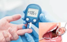 B&#237; quyết ngăn ngừa biến chứng răng miệng ở người bệnh tiểu đường