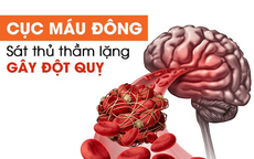 5 thói quen xấu gây hình thành cục máu đông trong lòng mạch, đe dọa sức khỏe