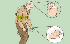 Biểu hiện cho thấy bạn mắc bệnh Parkinson