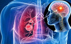 5 b&#237; quyết ph&#242;ng ngừa ung thư phổi cần biết