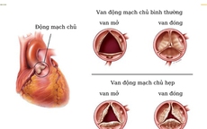 Biến chứng nguy hiểm hẹp van động mạch chủ v&#224; c&#225;ch điều trị
