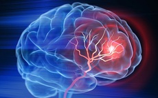 Sau cơn thiếu máu não thoáng qua, 72 giờ đầu cần làm gì để tránh đột quỵ não?