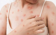 Cảnh báo thủy đậu ở người lớn có thể gây biến chứng nguy hiểm