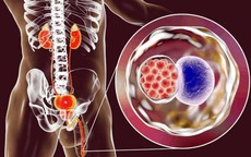 3 bệnh lây truyền qua đường tình dục làm tăng nguy cơ ung thư cổ tử cung