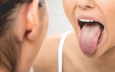 Bị ung thư lưỡi di căn hạch do chủ quan từ vết loét nhỏ