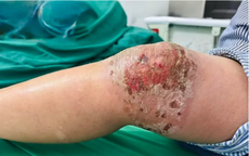 Viêm da, nhiễm trùng nặng do tự đắp thuốc nam, thuốc lá để điều trị đau khớp