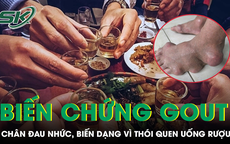 Bàn chân biến dạng, đau nhức dữ dội vì thói quen của nhiều đàn ông Việt