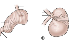 Xoắn dạ dày ở trẻ em rất nguy hiểm, cha mẹ cần phát hiện sớm