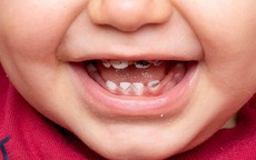 Sâu răng sữa có cần điều trị không?