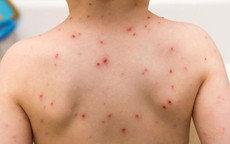 3 bệnh thường gặp ở trẻ vào mùa xuân