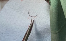 Kim khâu 'mắc kẹt' 11 năm ở tầng sinh môn của bệnh nhân