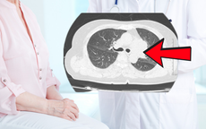 Không có triệu chứng hô hấp, người phụ nữ 40 tuổi vẫn phát hiện ung thư phổi