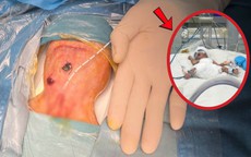 Bé trai sinh non 700 gram thủng ruột tự phát đặc biệt nguy kịch