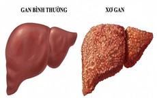 Dấu hiệu cảnh báo xơ gan không thể bỏ qua