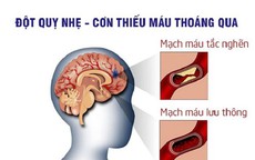 5 dấu hiệu nhận biết sớm cơn thiếu máu não thoáng qua