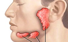 Sưng đau dưới lưỡi, cảnh giác với sỏi tuyến nước bọt