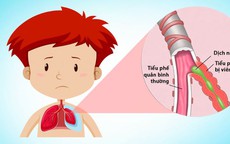 Vì sao trẻ ho nhiều, khò khè kéo dài?