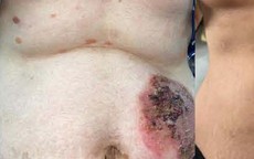 Giải cứu người phụ nữ 7 năm chung sống với các nốt bọng nước đau rát