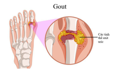 Vì sao người trẻ có thể mắc gout?