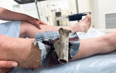 Chân chống xe máy găm cẳng chân, người đàn ông phải mang cả vào phòng cấp cứu